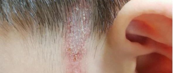 6岁男孩脸部皮肤溃烂，只因碰了这个小东西！杭州夏秋季节也很多，遇到千万别打
