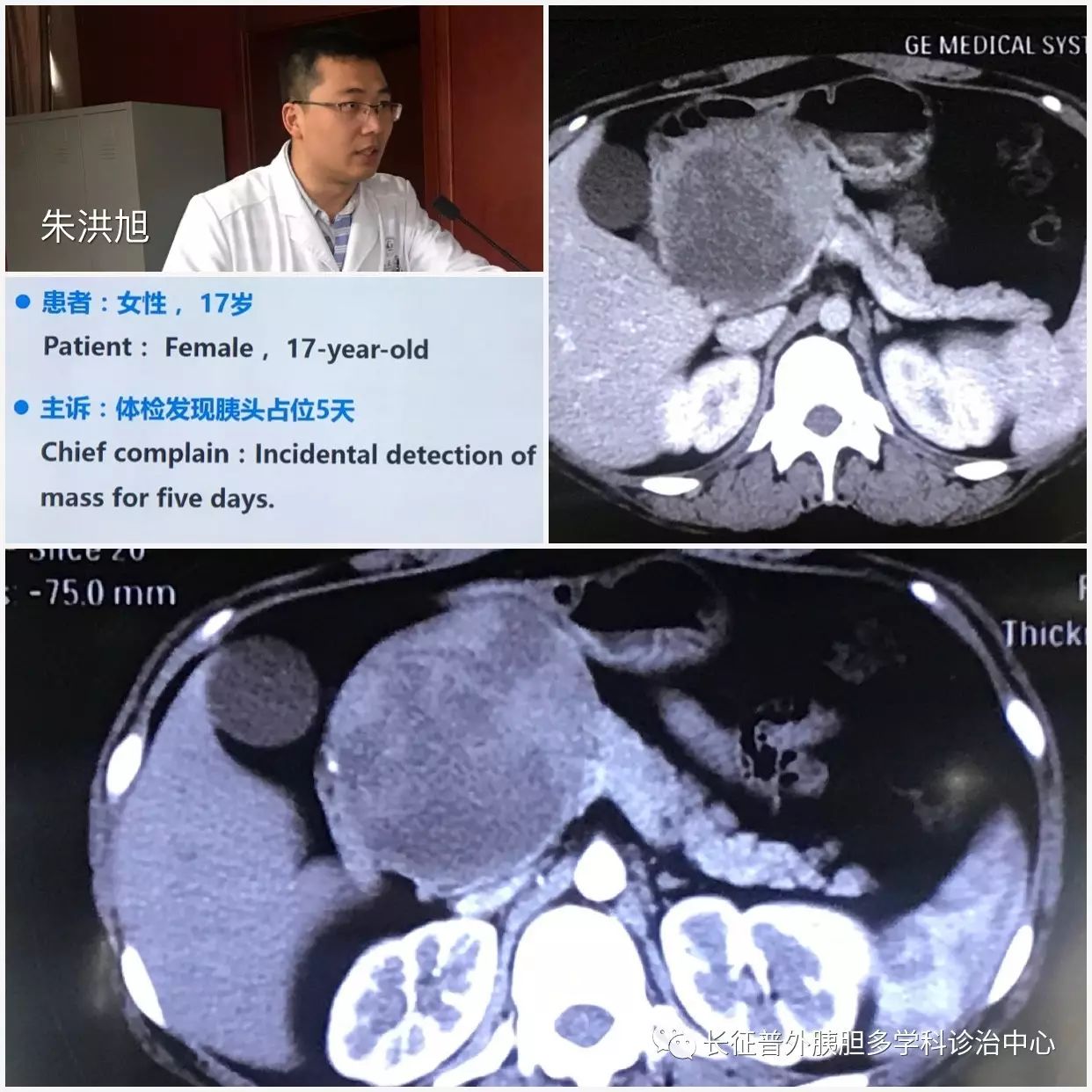 无典型spt蛋壳样钙化或肿块内散在钙化灶存在,其胰头部巨大囊实性占位