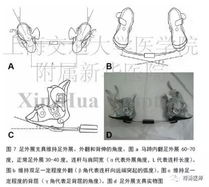 马蹄内翻足指南:建议二胎妈妈或者准备二胎的妈妈阅读