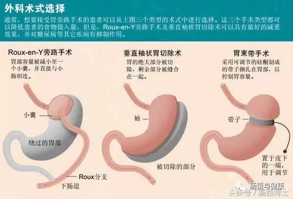 减肥手术后遗症_手术减肥_减肥手术有什么危害