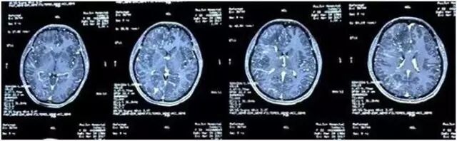 满脑子寄生虫源于贪恋生食