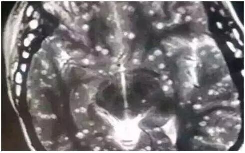 满脑子寄生虫源于贪恋生食