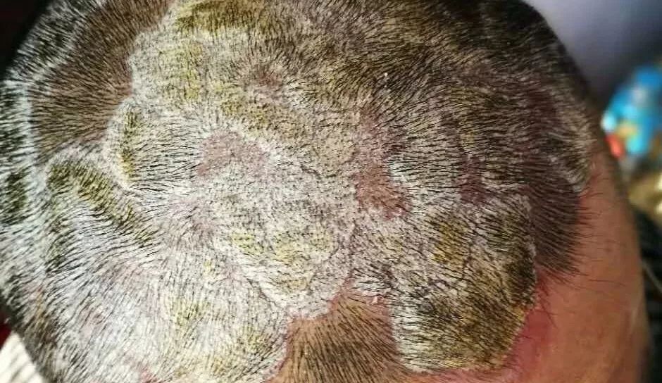 头癣一般是头皮和头发的浅部真菌感染,大多数头癣患者会出现白色头皮