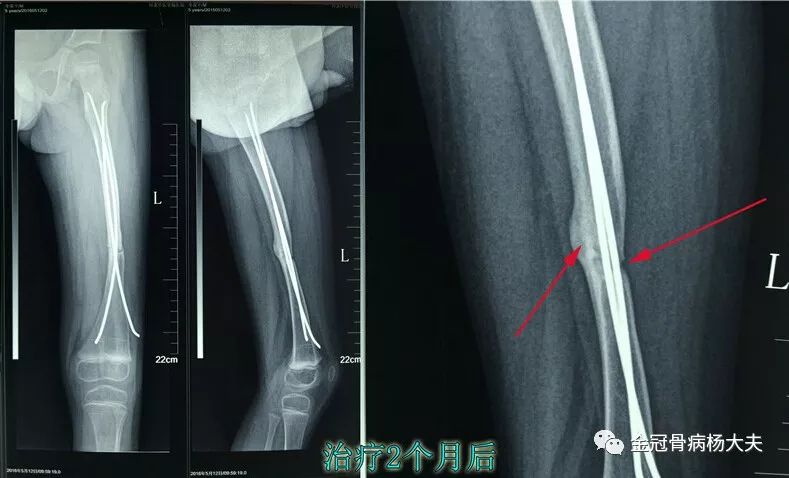 治疗5个月后,大量的骨痂形成,骨折线消失    骨折后半年骨折裂缝