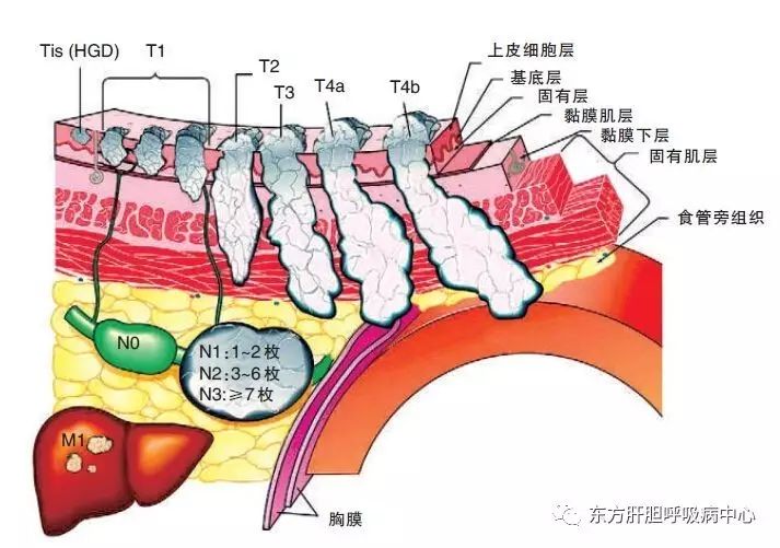 在中国,食道癌的发病有明显的 家族聚集与地理聚集现象,高发病率及高