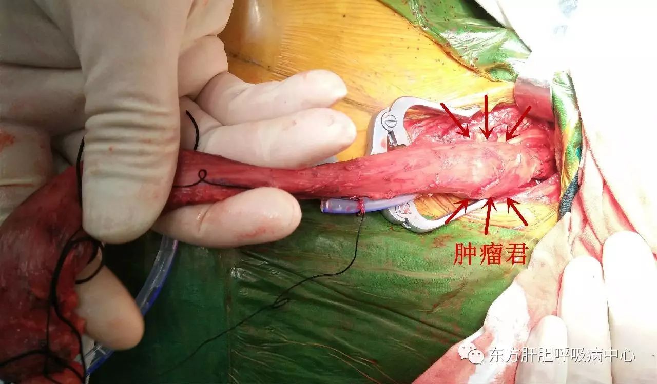 打开颈部切口,游离肿瘤