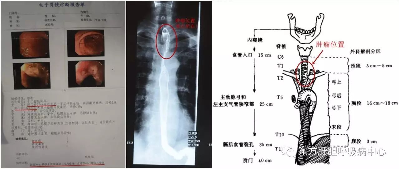 而 关键就在于上处的肿瘤,位于 食管上段, 距离门齿仅20