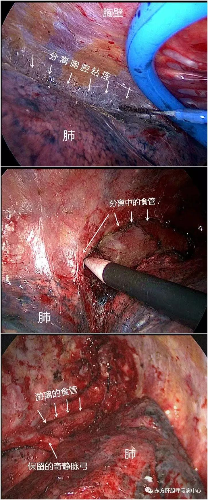 其四,全胸腔黏连的食管癌微创手术,技术与耐心的双重考验!