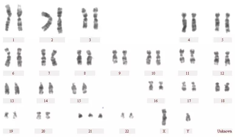 患儿体细胞染色体为47条,有一个额外的21号染色体,核型为47,xx(或xy)