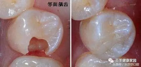 烂牙根一般几年内必须拔_拔烂牙根有危险吗_拔掉烂牙根多久才能补牙