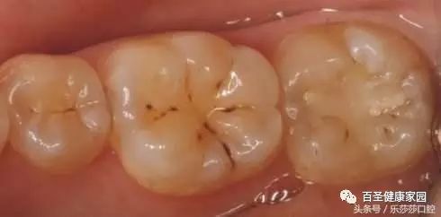 拔烂牙根有危险吗_烂牙根一般几年内必须拔_拔掉烂牙根多久才能补牙