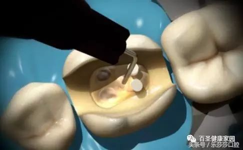 烂牙根一般几年内必须拔_拔烂牙根有危险吗_拔掉烂牙根多久才能补牙