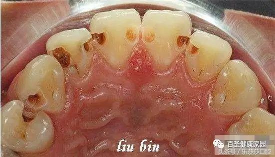 拔掉烂牙根多久才能补牙_拔烂牙根有危险吗_烂牙根一般几年内必须拔