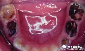 烂牙根一般几年内必须拔_拔掉烂牙根多久才能补牙_拔烂牙根有危险吗