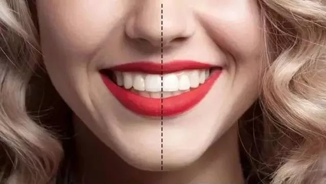 正常牙齿应该是尖对沟咬合,非正常的咬合属于尖对尖咬合.