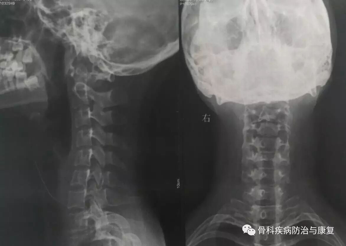 症状的描述,我给小黄拍了一个颈椎的x光片,x诊断结果提示: "颈椎反弓"