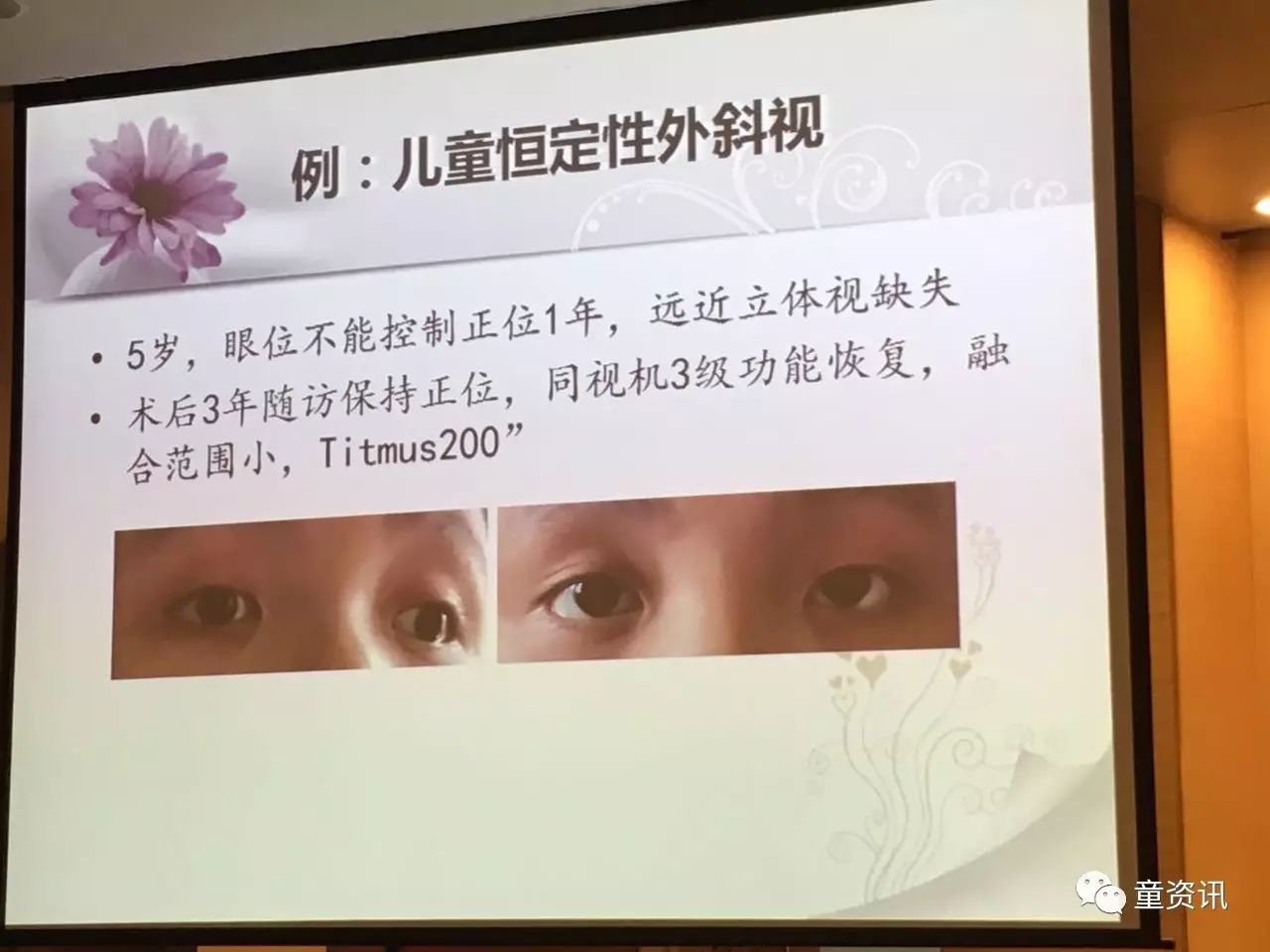 新生儿是没有完整双眼视,出生后3-5个月融合和立体视开始发育.