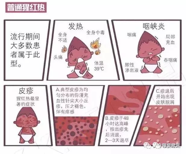 猩红热是怎么引起的,小儿猩红热几天能好,猩红热怎么治疗