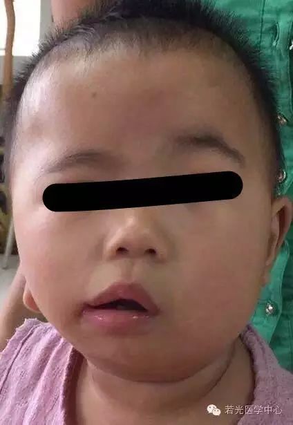 出生后发现面部不对称(右脸小,耳部发育异常(残缺,无外耳道,口角裂
