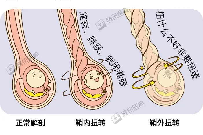 这期间可采用手术缓解扭转,尽量拯救蛋蛋