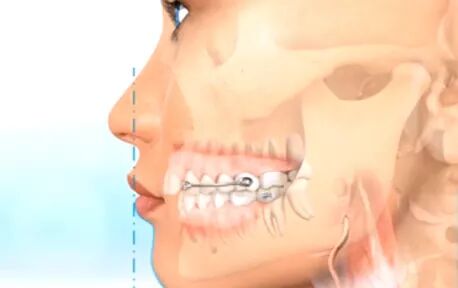 \