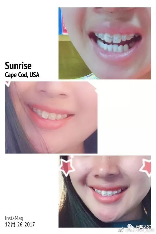 传统牙套和自锁牙套_自锁牙套需要拔牙吗_自锁牙套