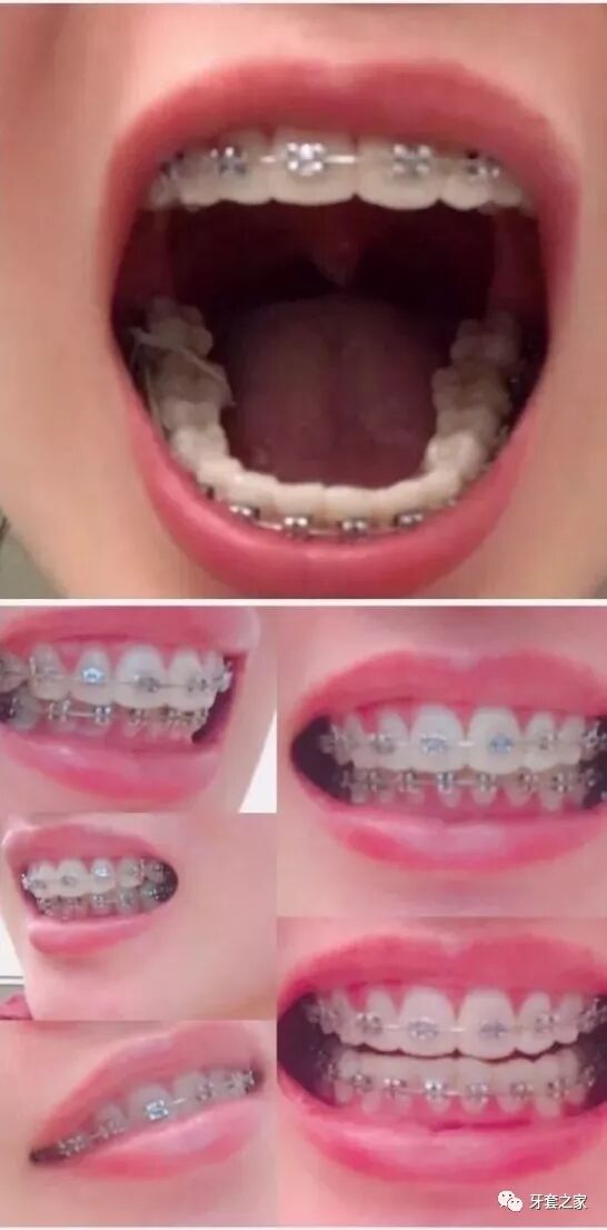 普通托槽和自锁托槽_牙套托槽自锁_普通牙套托槽种类图片