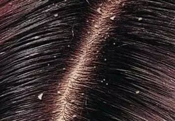 【村医讲堂】头皮屑提示了什么？