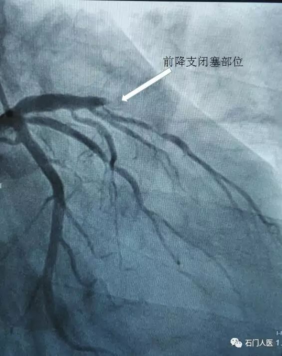 △造影显示:左冠状动脉前降支近中段完全闭塞