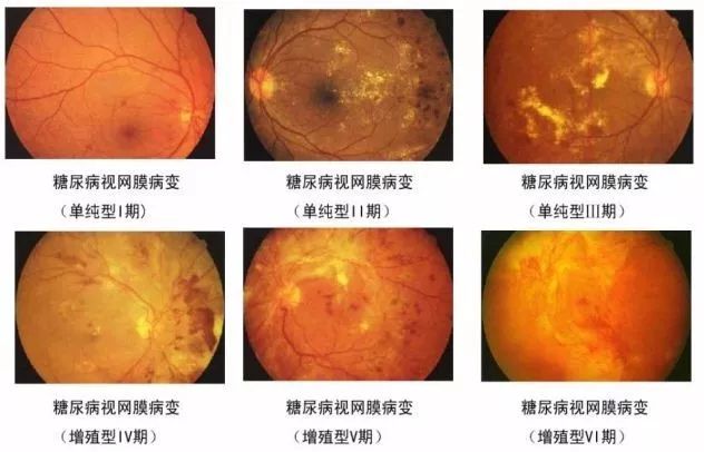 糖尿病在不同时期下所造成的视网膜病变情况