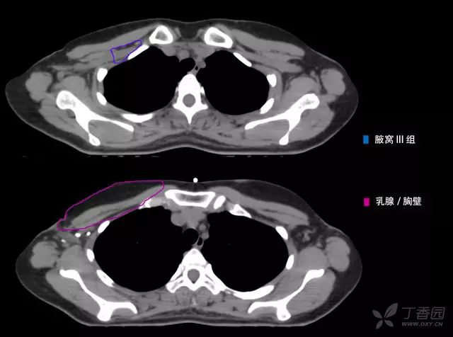 病例 1:左侧乳腺癌术后 t3n3(11/5)m0 iiib 期(下图仅显示锁骨上 ctv