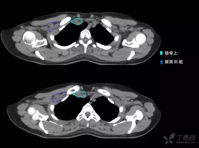 病例 1:左侧乳腺癌术后 t3n3(11/5)m0 iiib 期(下图仅显示锁骨上 ctv