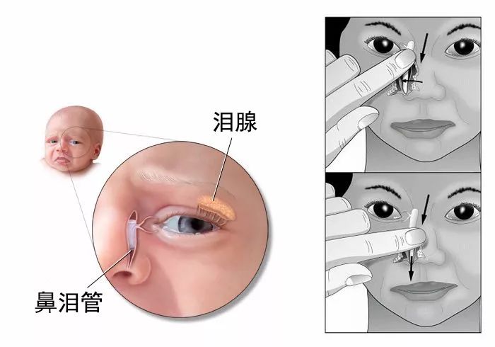 泪道按摩方法:从宝宝内眼角的位置开始,稍稍施加压力,顺着鼻泪管向下