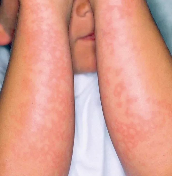临床实用总结:常见小儿发热出疹性疾病2