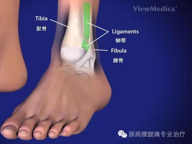 中英文字幕 高位踝关节扭伤 High Ankle Sprain Syndesmosis Ligament Injury 自由微信 Freewechat