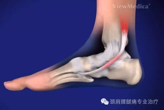 中英文字幕 胫后肌腱功能障碍 Posterior Tibial Tendon Dysfunction 自由微信 Freewechat