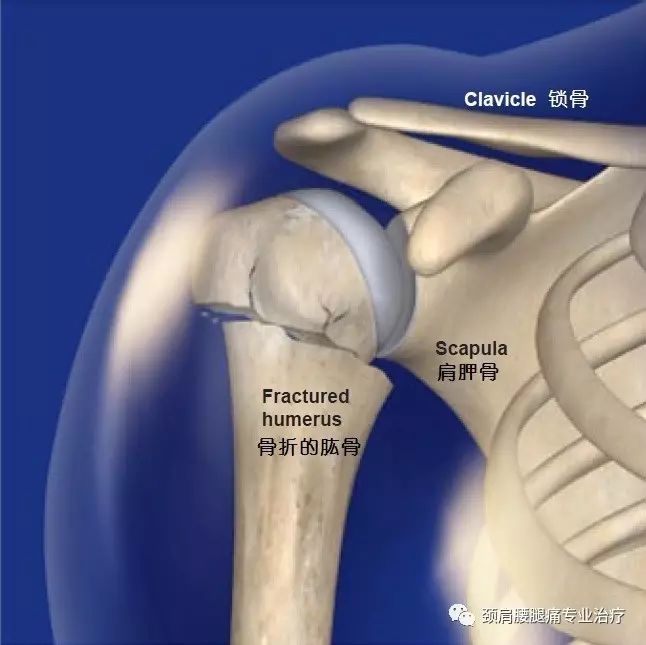 中英文字幕:肱骨近端骨折切开复位内固定术(orif surgery for