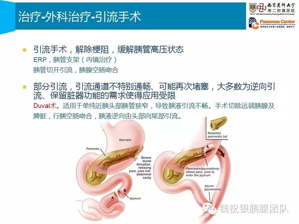 胰管结石,慢性胰腺炎的引流手术