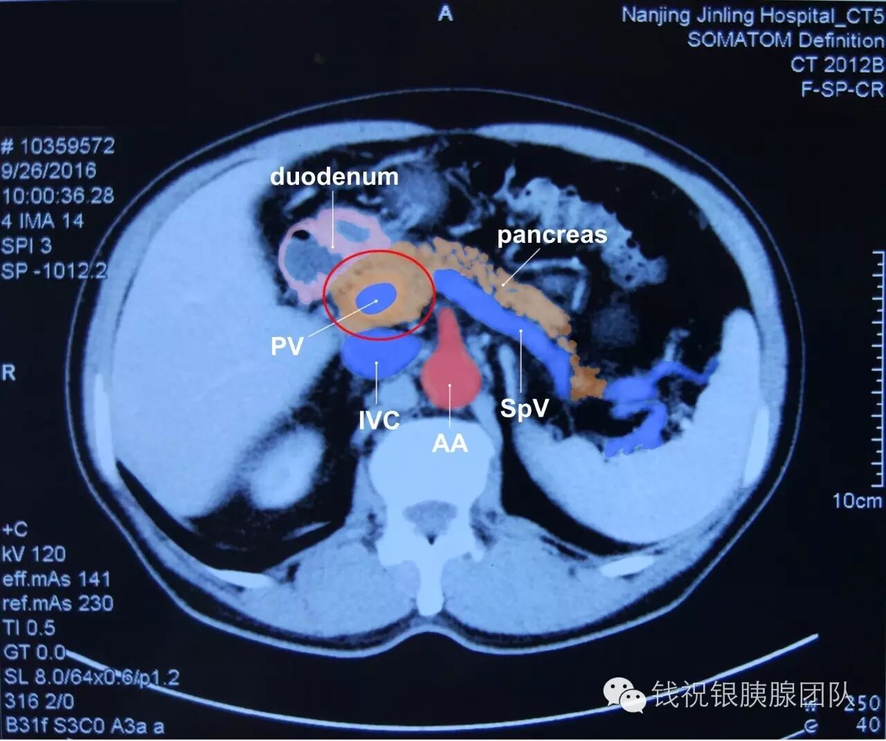 whipple术中发现罕见胰腺畸形1例——胰腺融合异常 (转载)