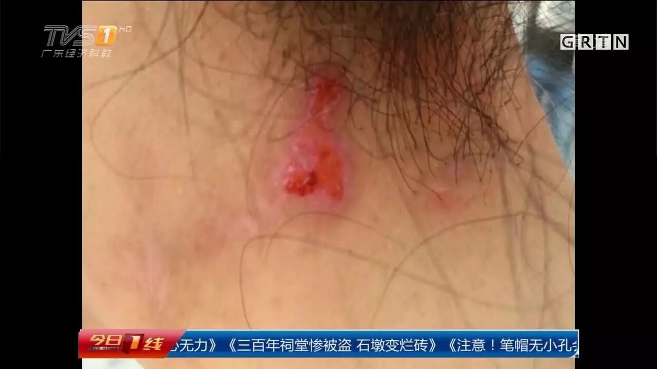 深圳女子烫发皮肤裂开直喊痛 竟是药水腐蚀了皮肤