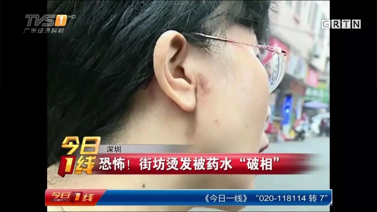 深圳女子烫发皮肤裂开直喊痛 竟是药水腐蚀了皮肤