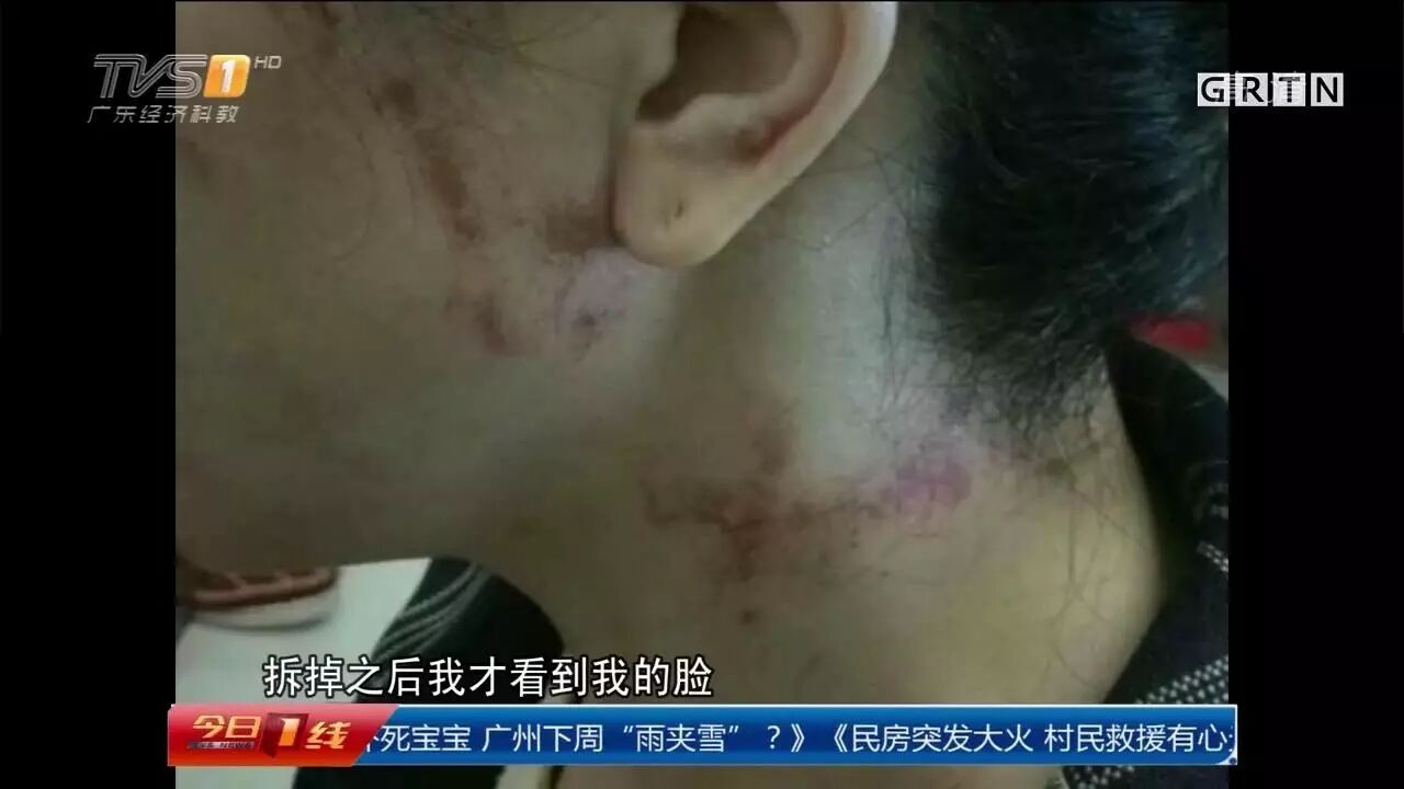 深圳女子烫发皮肤裂开直喊痛 竟是药水腐蚀了皮肤