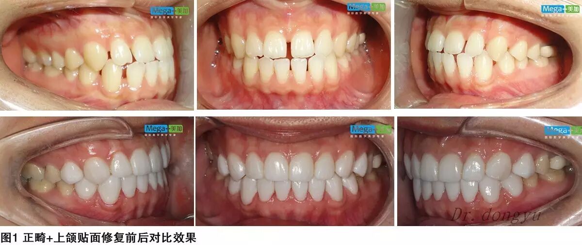微创美学修复 ——正畸与美加超薄美牙贴面的联合