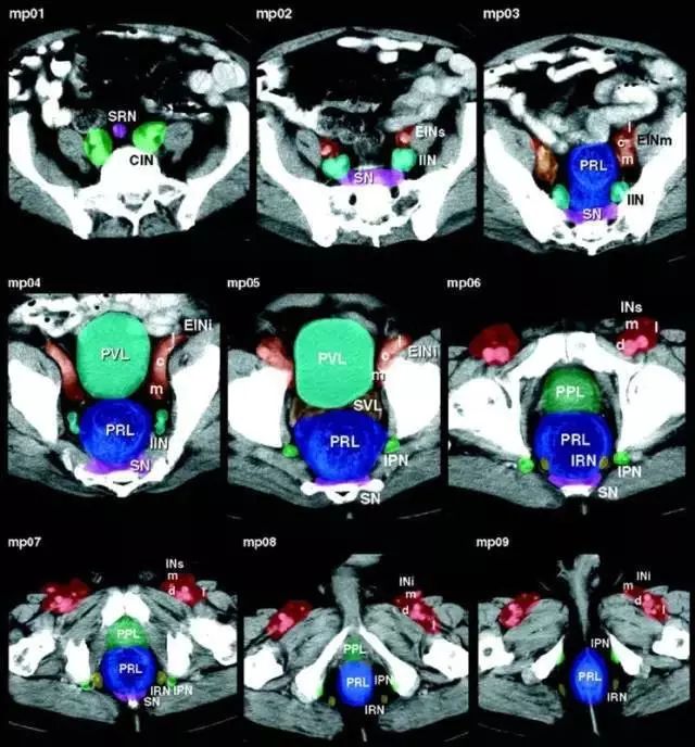 【临床美图】全身各区域淋巴结 ct 图谱!