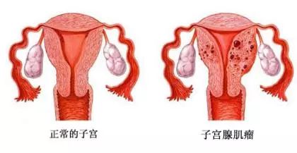 采用一次性穿刺针经阴道穿刺奥洛克去除子宫腺肌症局部病灶