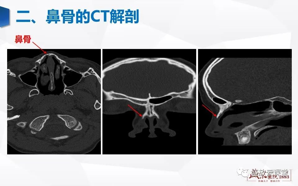 鼻骨正常ct解剖变异与骨折