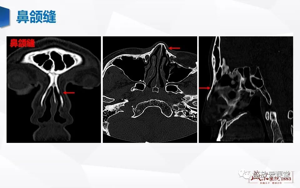 鼻骨正常ct解剖变异与骨折