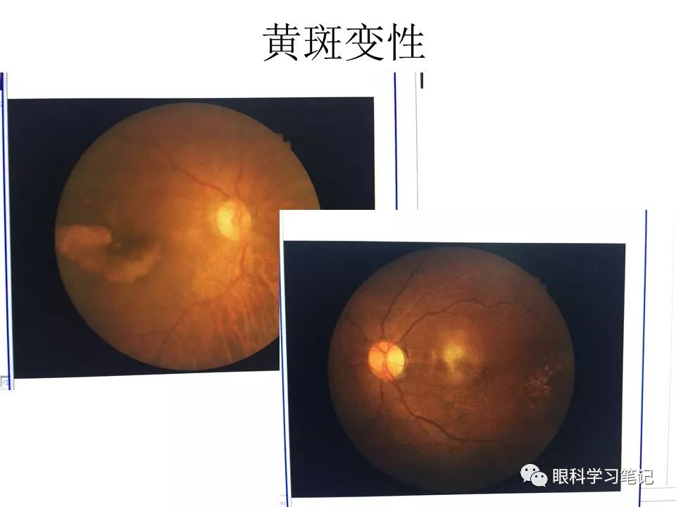 老年性黄斑变性简要问答 (转载)