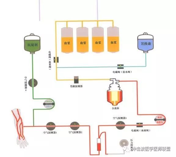 血浆置换治疗hellp综合征并发多脏器功能障碍综合征