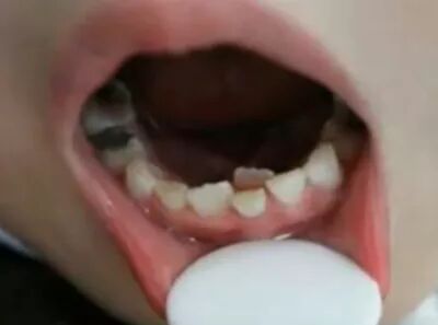 6岁女童牙后长牙成"双排牙",很多孩子中招,竟因家长照顾太周到